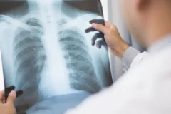 Anvisa aprova novos tratamentos avançados para câncer de pulmão e de mama