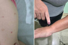 Mistério dermatológico em Brodowski: cidade investiga surto de manchas e coceira