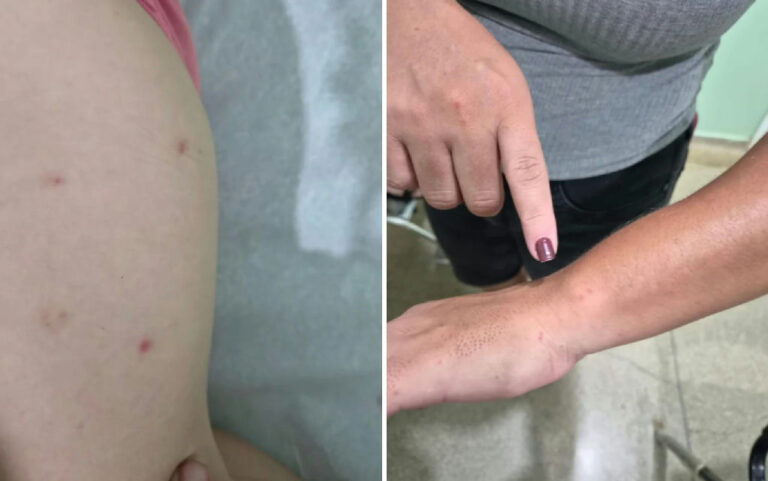 Mistério dermatológico em Brodowski: cidade investiga surto de manchas e coceira